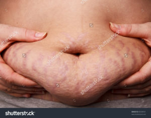 big-tummy-with-stretch-marks-300x234